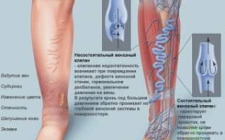 Операция по удалению вен на ногах последствия отзывы