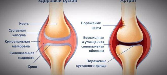 Артрит мелких суставов стопы лечение