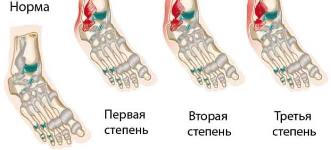 Разрыв связок на щиколотке