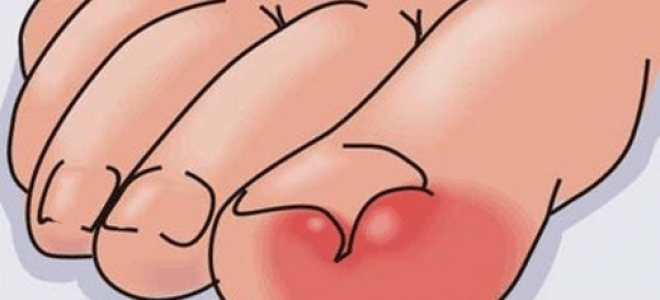 Нарывает палец на ноге около ногтя