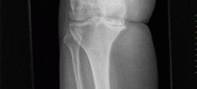 Артроз третьей степени коленного сустава