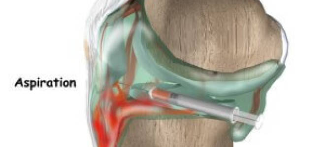 Гемартроз коленного сустава после травмы