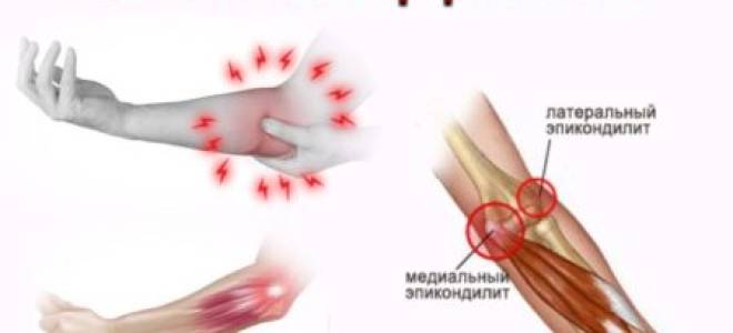Эпикондилит локтя как лечить