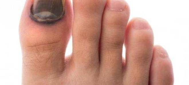 Если ноготь почернел на ноге от ношения тесной обуви что делать