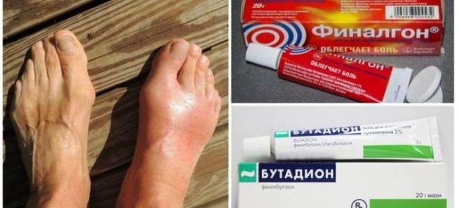 Мази при подагре на ногах в период обострения