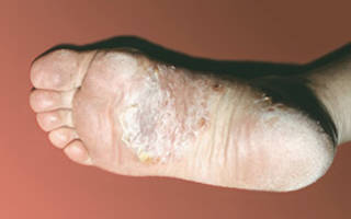 Как выглядит псориаз на начальной стадии фото на ногах?