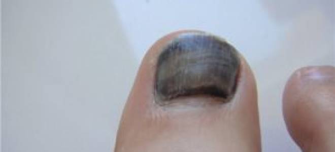 Ушиб ногтя большого пальца ноги лечение фото