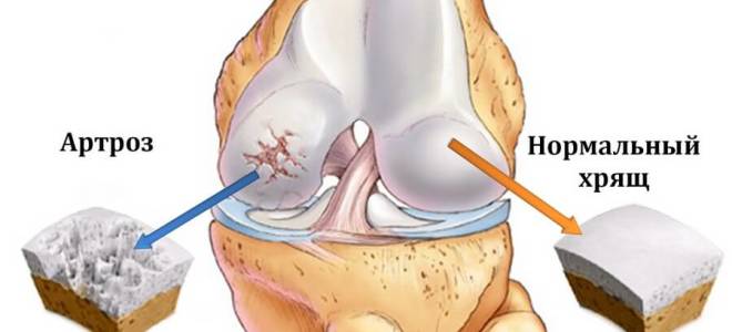 Полиостеоартроз с поражением коленных суставов