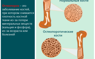 Снижение минеральной плотности костной ткани