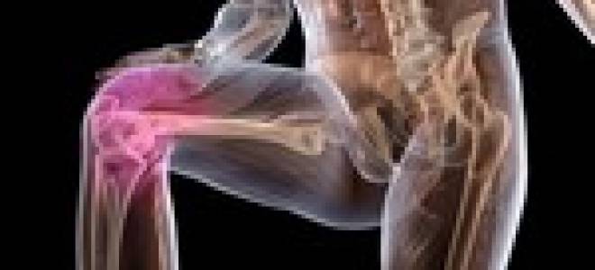 Синовит болезнь коленного сустава