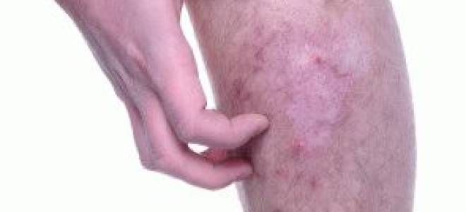 Покраснение и зуд на ноге в области голени