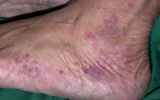 Венозный дерматит фото симптомы и лечение у взрослых на ногах