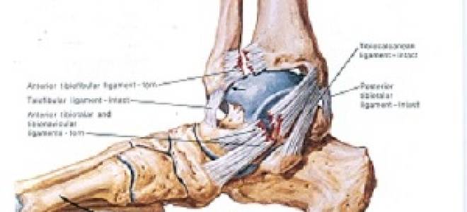 Частичный разрыв связок голеностопного сустава лечение