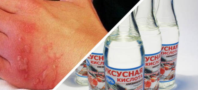 Мазь от ожога уксусом