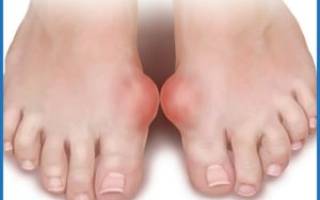 Препараты при подагре в период обострения