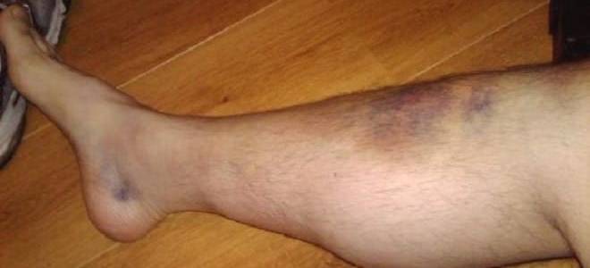 Лопаются сосуды на ногах и появляются синяки лечение и причины