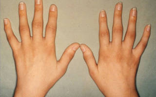 Чем лечить ревматоидный артрит суставов