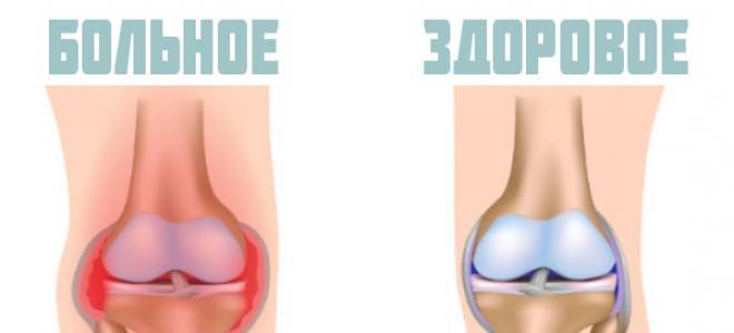 Кровь в суставе колена