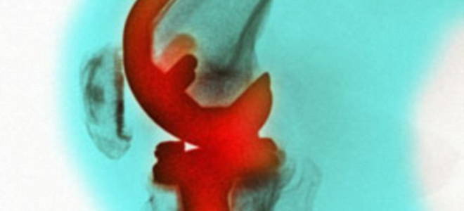 Деформирующий артроз коленного сустава 1 степени лечение