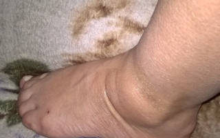 Опухоль на ноге возле косточки