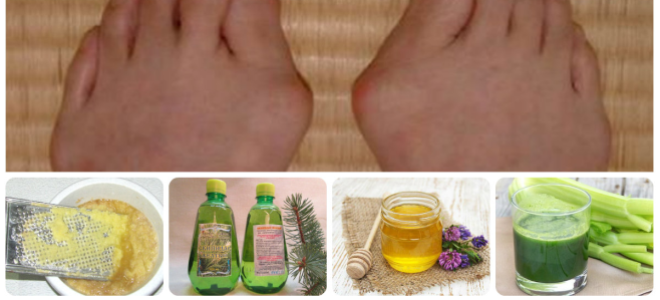 Как убрать косточку на ноге у большого пальца народными средствами?