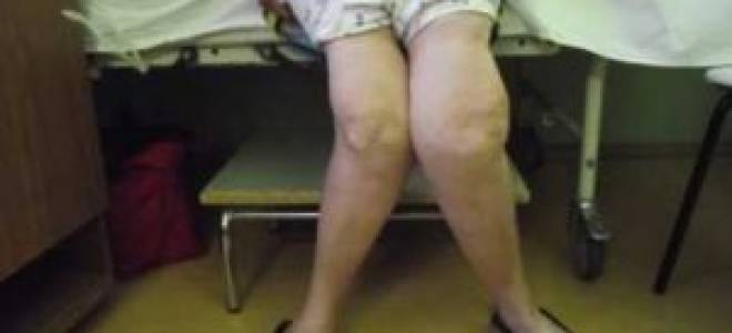 Артроз коленного сустава 3 степени 4 степени