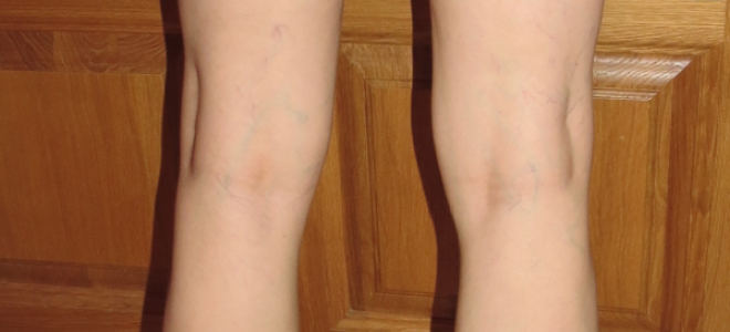 Удаление лазером сосудистых звездочек на ногах отзывы