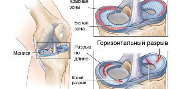Мениск поврежден что делать