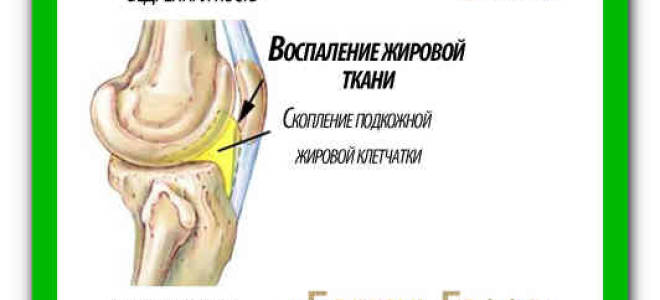 Болезнь гоффа коленного сустава лечение народными средствами