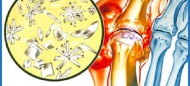 Заболевание подагра на ногах как лечить