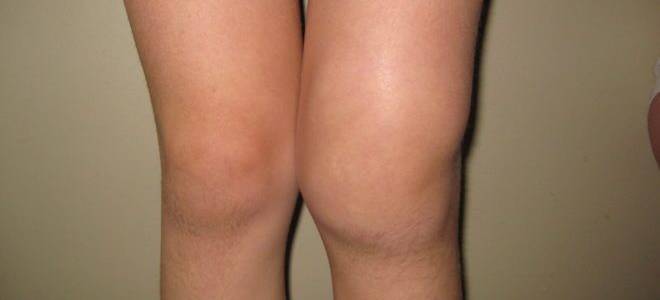 Лечение артрозоартрит коленного сустава