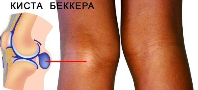 Отчего болят колени при сгибании
