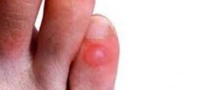 Как лечить мокрую мозоль на пальце ноги?