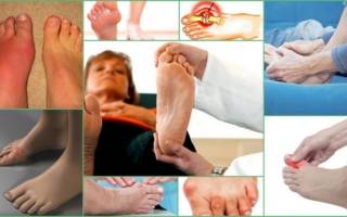 Подагра что за болезнь у женщин симптомы и лечение