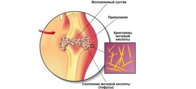 Каша манная при подагре
