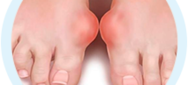 Удаление косточки на ноге лазером спб цена